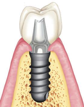 impianti Leone TIPOLOGIE DI IMPIANTI Il sistema implantare Leone offre quattro tipologie di macro-design implantare: - Impianto Classix caratterizzato da una geometria cilindrica; - Impianto Max