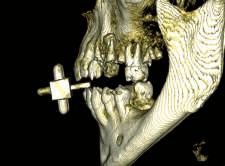 ODONTOTECNICO MASCHERINA