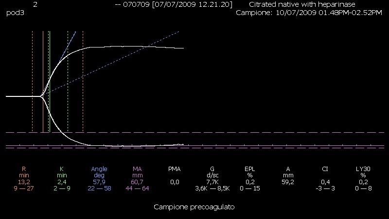 44: tracciato tromboelastografico ottenuto con Kaolino ed eparinasi, in terza giornata di post-operatorio.