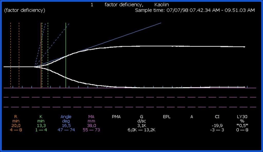 Deficit fattori della coagulazione Fig 17: tracciato tromboelastografico tipico di deficit dei fattori della coagulazione.
