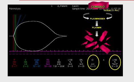 Fibrinolisi primaria Fig. 20: tracciato tromboelastografico che rispecchia una situazione di fibrinolisi primaria.