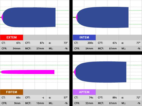 Fig. 22: Tracciati ottenuti con ROTEM utilizzando diversi tipi di reagenti. Ogni modifica altera la specificità e la sensibilità del sistema.