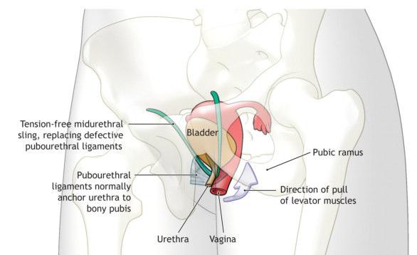 i legamenti pubo-uretrali prevengono l'ipermobilità e la dislocazione verso il basso