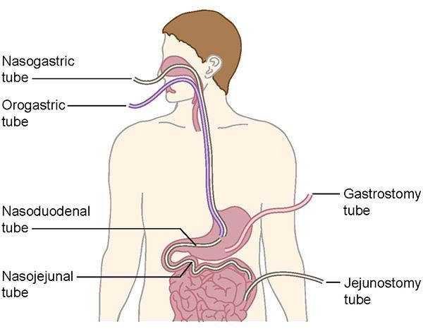 Tecnica in cui gli alimenti vengono somministrati al corpo attraverso il tratto gastrointestinale NE può essere orale, nasogastrica, nasoduodenale,