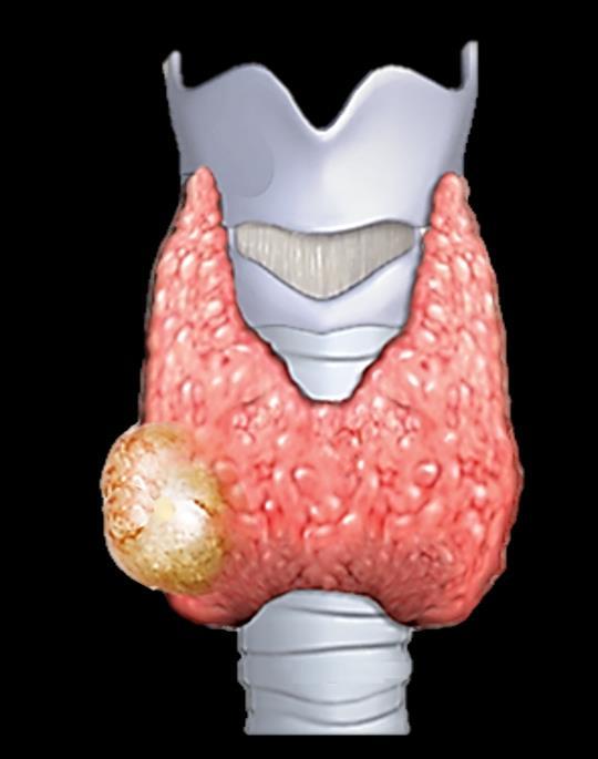 Viene definito nodulo tiroideo una lesione individuabile all interno della tiroide, distinta dal circostante parenchima