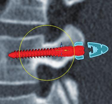 6 3D Disponibile da febbraio 2019 La pianificazione preoperatoria in 3D