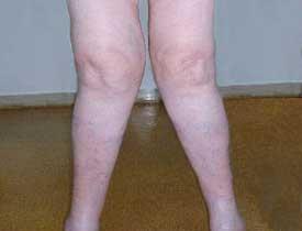 Il ginocchio valgo è una deformità dell'arto inferiore che