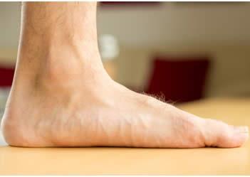 Il piede piatto è una alterazione della disposizione delle ossa del piede :il piede appoggia al terreno con tutta la sua superficie Il risultato di