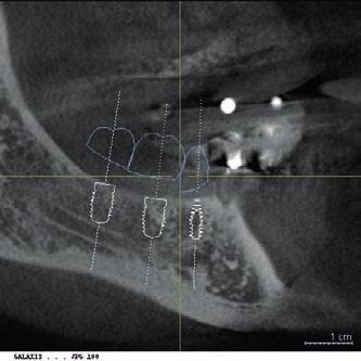 In prima seduta, attraverso uno scanner intraorale (CEREC AC Bluecam, Sirona Dental
