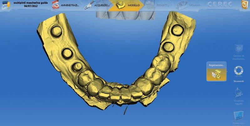 realizzare un progetto implantoprotesico estremamente accurato, dove la forma e la