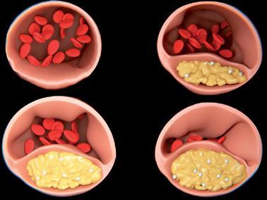 ATEROSCLEROSI: REGOLE DIETETICHE Per prevenzione l aterosclerosi bisogna seguire una dieta che: riduca il colesterolo totale introdotto con gli alimenti; riduca gli acidi grassi saturi; aumenti