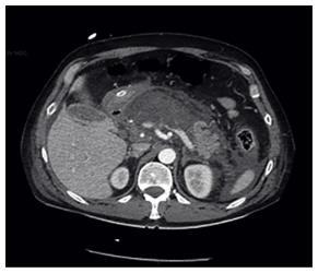 PANCREATITI