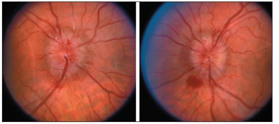 Disturbo visivo transitorio binoculare Durata: alcuni secondi Durata di