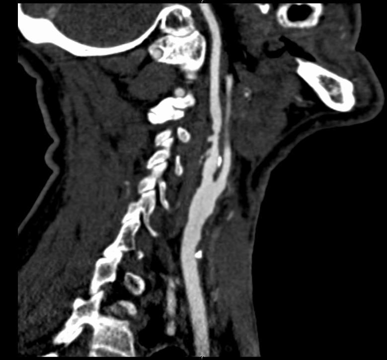 AMAUROSIS FUGAX: PATOGENESI EMBOLICA ARTERO-ARTERIOSA L angio -TC con ricostruzione