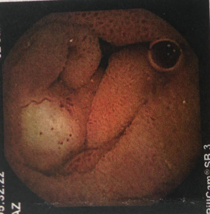 Video capsula A 4 h e 17 la mucosa si presenta distrofica, lievemente iperemica, irregolare, con piccole nodularità biancastre