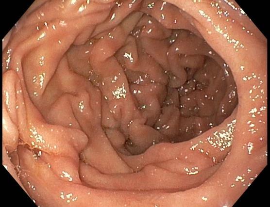 cieco, mucosa normale e ben distensibile