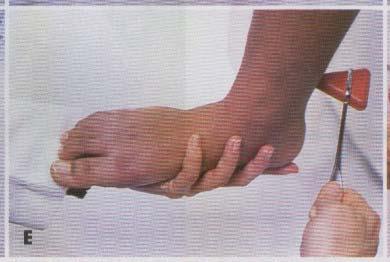 Riflesso achilleo: la percussione del tendine di Achille al calcagno determina la flessione plantare del piede (nervo sciatico L5) RIFLESSI NERVOSI superficiali fisiologici profondi superficiali