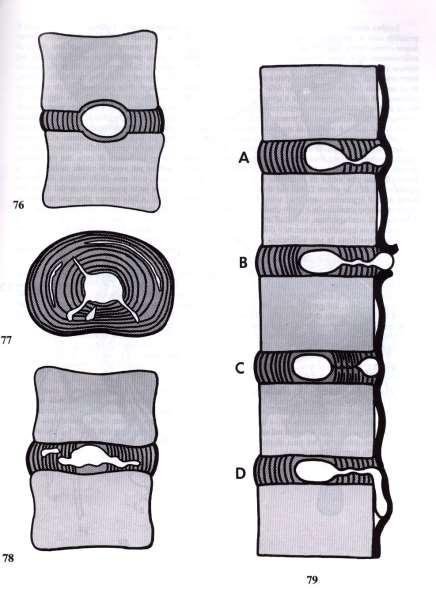 Tipi di ERNIA Discale 1 1) Ernia Intra-spongiosa ( cedimento dei piatti vertebrali, quando le fibre dell anello fibroso resistono) 2 2) Degenerazione delle fibre dell anello fibroso (dopo i 25 anni