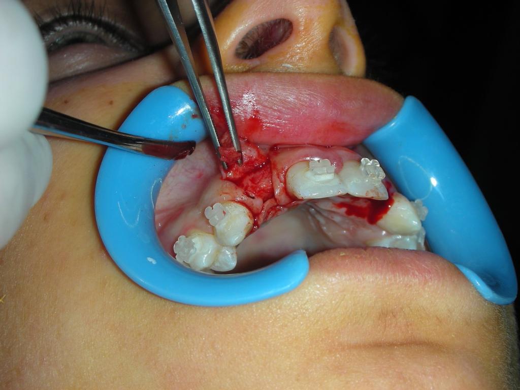 Dettaglio del lembo sopra descritto: sono evidenti le incisioni, ed il prelievo di tessuto connettivo palatale peduncolato (irrorato) dal