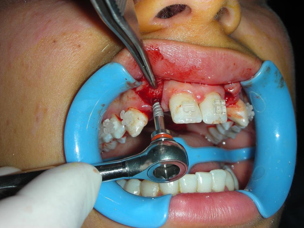 Mediante osteotomi da 2, e da 3 mm con punta convessa è stata completata la preparazione osteotomica, ottenendo