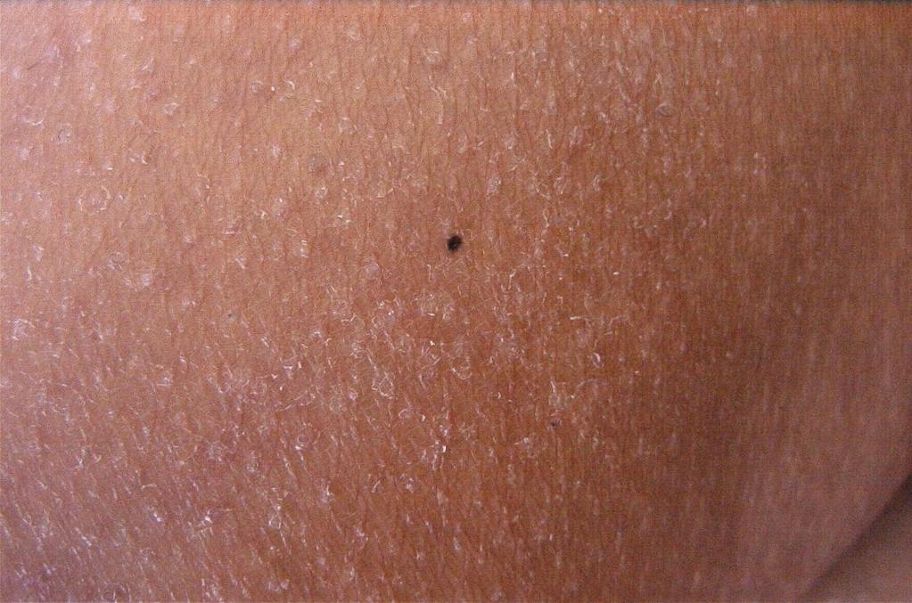 melanoma a diffusione superficiale,