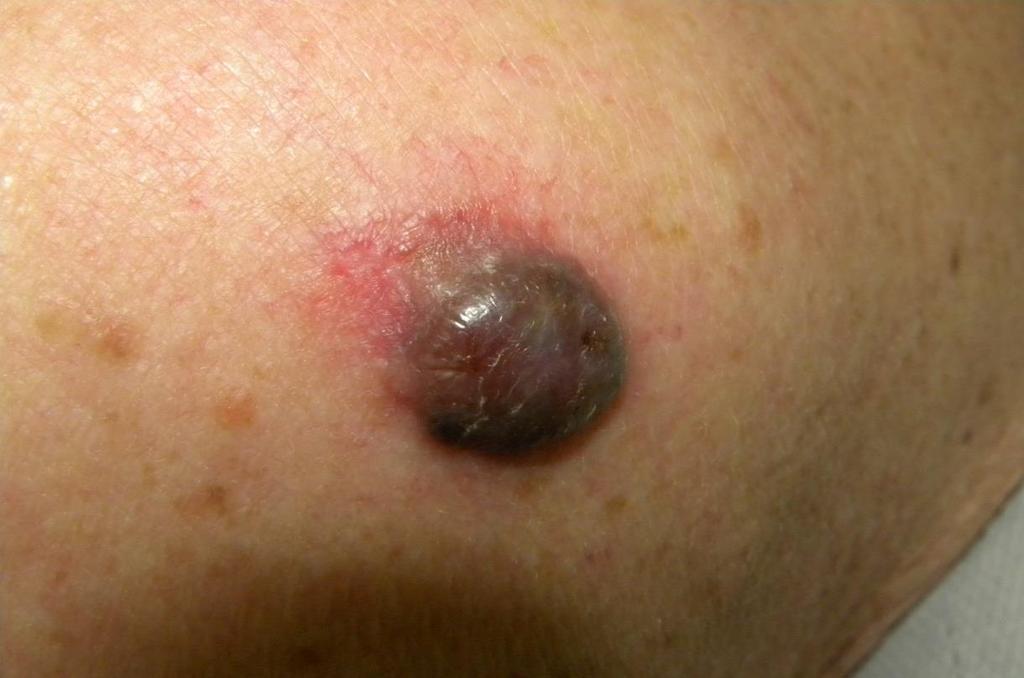 melanoma nodulare,