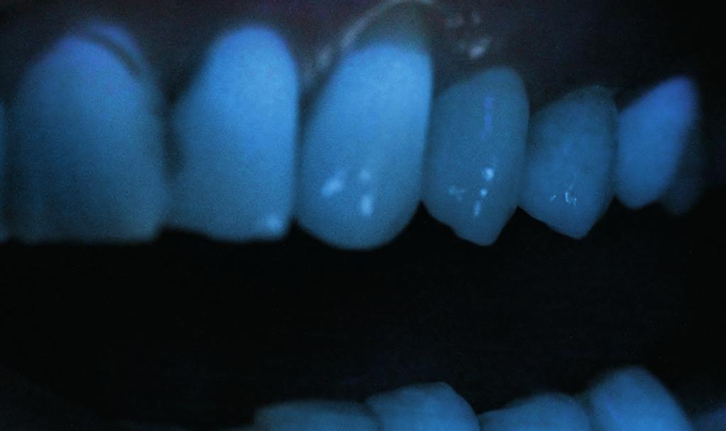 Immagine labiale Sezione Corona anteriore A2 in 3M Lava Esthetic Zirconia. Fonte: dati interni 3M Orale Care.