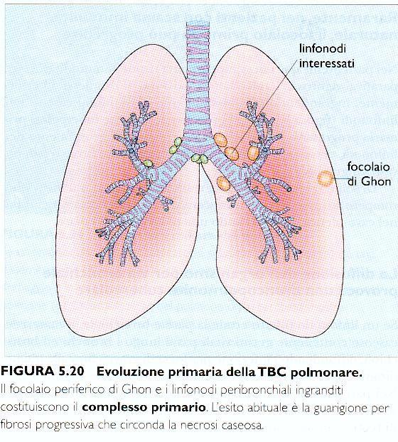 Tubercolosi primaria Complesso primario Localizzazione del M. nel focolaio periferico di Ghon e nei linfonodi peri-bronchiali formazione di granulomi con necrosi caseosa.