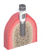 Passo 3 Inserimento del cilindro di posizionamento I cilindri di posizionamento presentano un indicatore sul lato piatto (pulsante esterno) che identifica il lato interno.