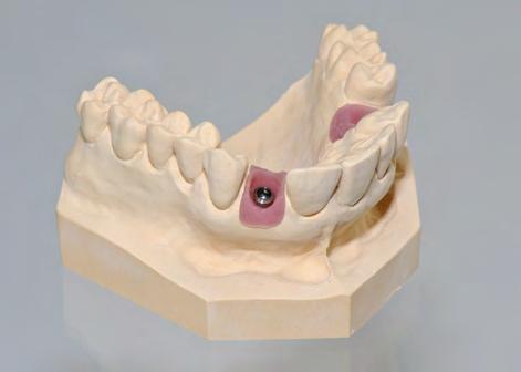 Procedura per odontotecnico: Alcuni prodotti illustrati possono non essere disponibili in determinati paesi.