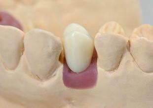 Passo 5 Rifinitura e rivestimento della struttura Si passa quindi alla lavorazione finale della struttura e si definisce lo spessore in base alle linee anatomiche.