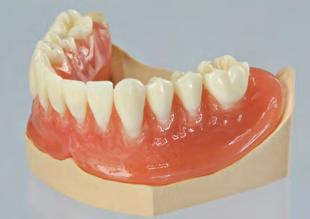 Realizzazione di una protesi overdenture con involucri per matrice LOCATOR Con le componenti LOCATOR è possibile realizzare una nuova protesi overdenture o migliorarne una già esistente e