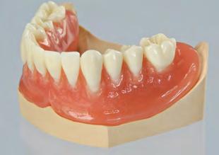 Passo 4 Ribasatura della protesi overdenture Eseguire la ribasatura della protesi overdenture come di consueto, aggiungendo l involucro della matrice LOCATOR.