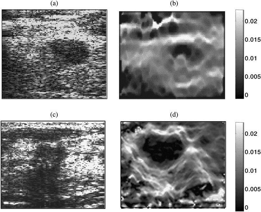 Storia dell elastografia 1982: uso degli ultrasuoni nella