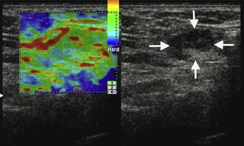 clinica 1996:si usa il termine real-time free hand USelastography