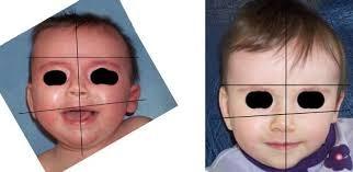 SEGNI CLINICI Clinicamente A livello visivo (Pons Dx) Testa a parallelogramma Cranio posteriore appiattito a destra Asimmetria facciale (occhi, naso, sopracciglia) Orecchio Dx anteriore e inferiore