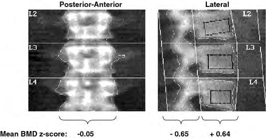 The BMD measurement at the lateral lumbar spine reflects bone loss and