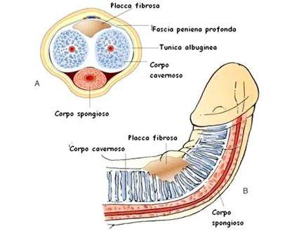 Def inizioni Trattamento chirurgico dell Induratio Penis Plastica Procedure di allungamento con