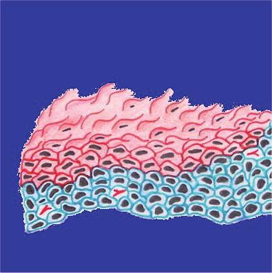 CIN 1 Le cellule neoplastiche occupano il