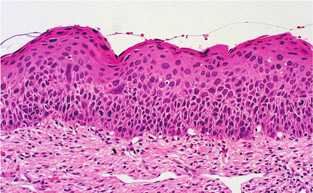 Indicatori morfologici di entrambe le forme Multinucleazioni Atipie tetraplodi Coilocitosi Iper-paracheratosi Atipie aneuploidi