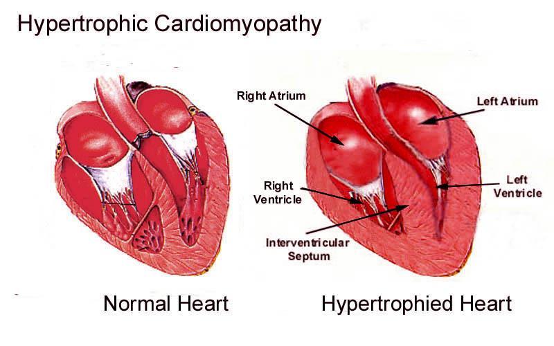 Ipertrofia cardiaca I miocardiociti rispondono a stimoli meccanici, come lo stiramento, con meccanismi che determinano la risposta