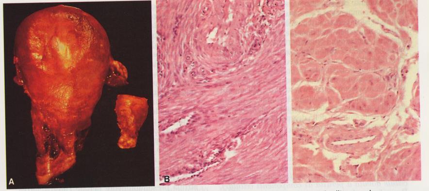 Rene Ipertrofia ed iperplasia in seguito a nefrectomia monolaterale (asportazione di uno dei due reni) Ipertrofia ed iperplasia. Ingrandimento dei glomeruli e dei tubuli.