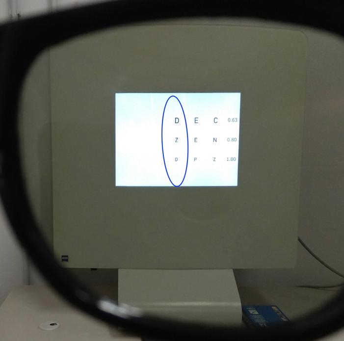 Dopo aver rilevato la refrazione o l eventuale sovra-refrazione, se portatori di correzione, si è passati alla verifica dello stato di bilanciamento binoculare utilizzando uno dei test soggettivi