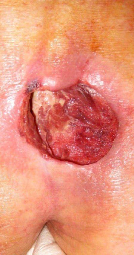 Infiammazione emorragica Tipica di processi infettivi della cute: vaiolo, tifo esantematico Fenomeni distruttivi dei tessuti e degli endoteli vasali con stravaso ematico (emorragia) Infiammazione