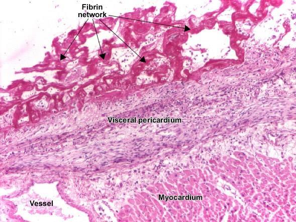 Infiammazione fibrinosa Caratteristica di forme di pericardite, pleurite e peritonite e in corso di infezione da pneumococchi e stafilococchi.