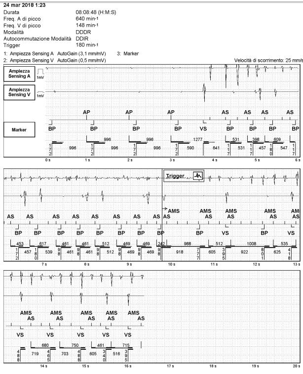 MS: un esempio Prima della visualizzazione dell episodio vengono riepilogati i dati dell episodio e la programmazione del dispositivo 1 2 3 Stimolazione bicamerale Inizio di aritmia atriale: