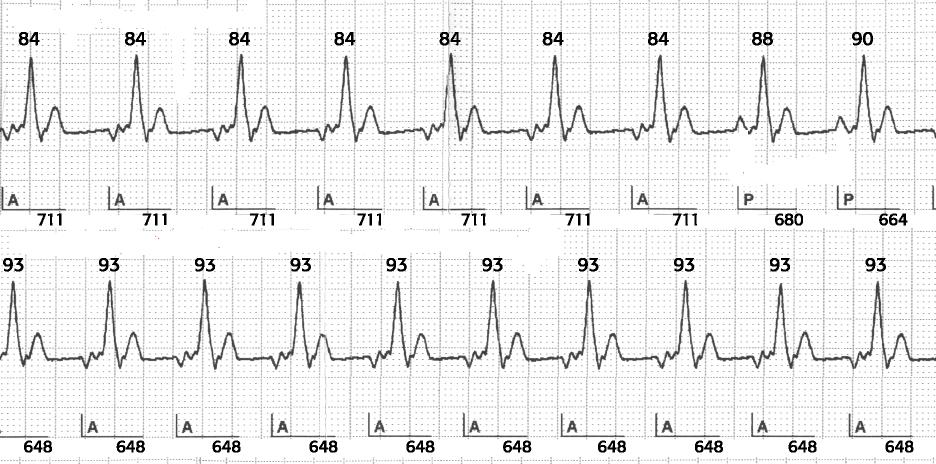 Overdrive atriale: un esempio 1 2 3 1. Stimolazione atriale ad 84 battiti/minuto (A) 1.