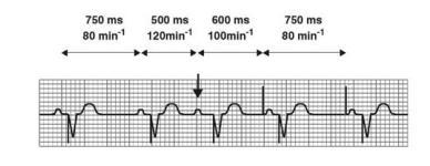 Stimolazione post-extrasistolica: un esempio 1 2 3 1. Ritmo sinusale a ciclo 750 msec 1.