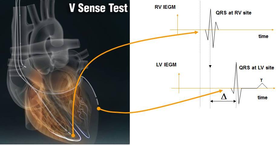 Ottimizzazione ritardi VV mediante EGM Quick-Opt (Abbot) Il dispositivo misura la velocità di propagazione dello stimolo nelle seguenti modalità: RV e LV spontanei (vedi fig.