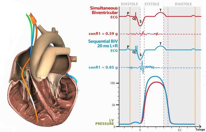 Ottimizzazione AV e VV: utilizzo del sensore Sensore a b a. Contrattilità cardiaca rilevata dal sensore in stimolazione biventricolare pura (0.